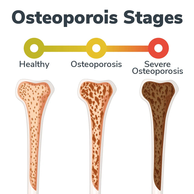 Prevent Osteoporosis: Your Personalized Bone Health Guide